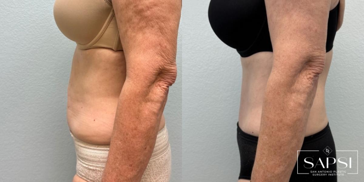 Tummy Tuck: Patient 4 - Before and After 3