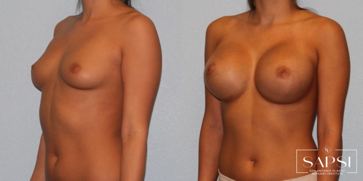 Breast Augmentation: Patient 16 - Before and After 2