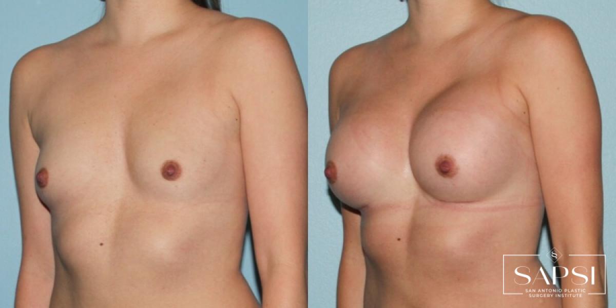 Breast Augmentation: Patient 8 - Before and After 2