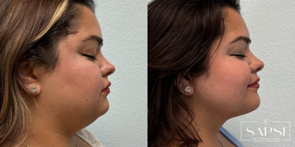 Liposuction: Patient 1 - Before and After 3