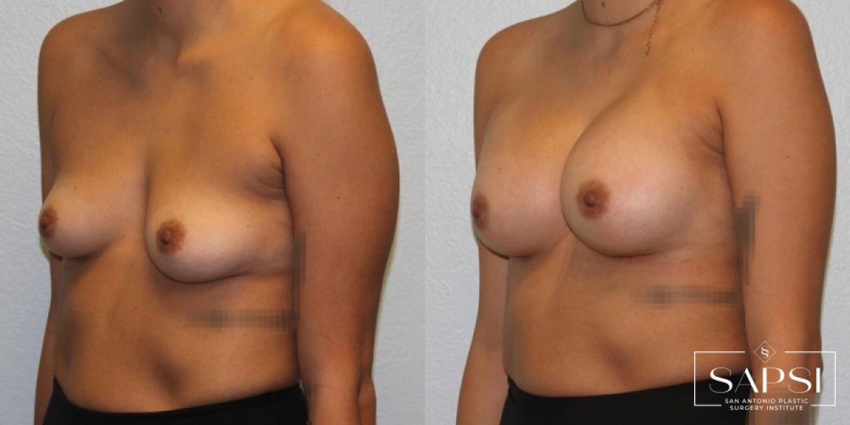 Breast Augmentation: Patient 29 - Before and After 2