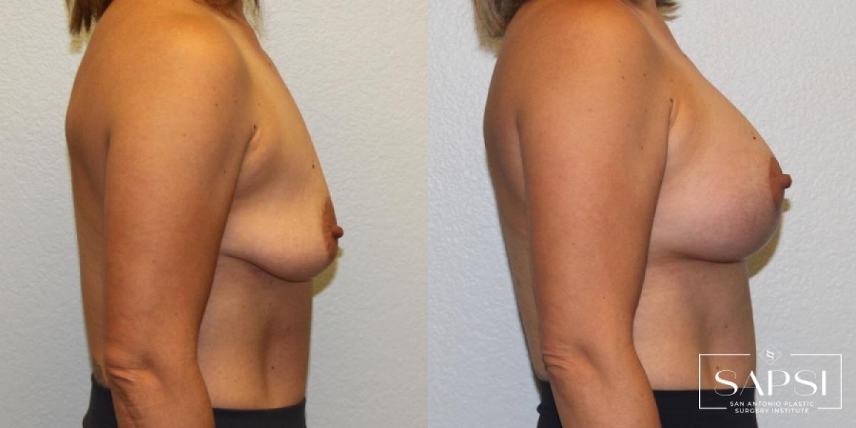 Breast Augmentation With Lift: Patient 4 - Before and After 3