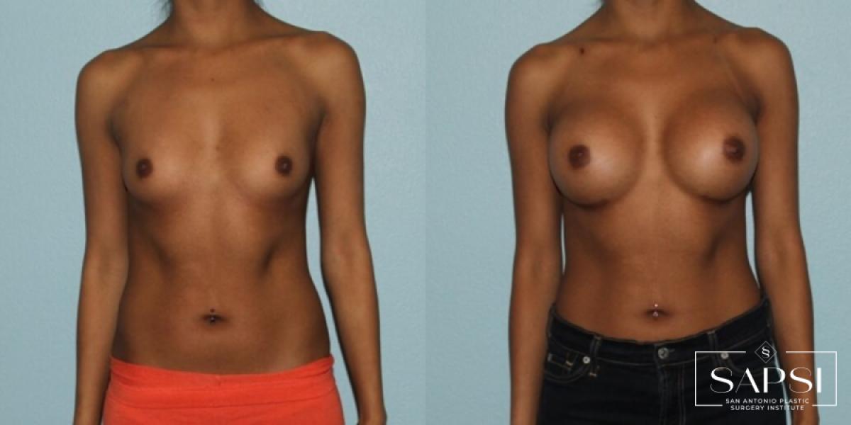 Breast Augmentation: Patient 44 - Before and After 