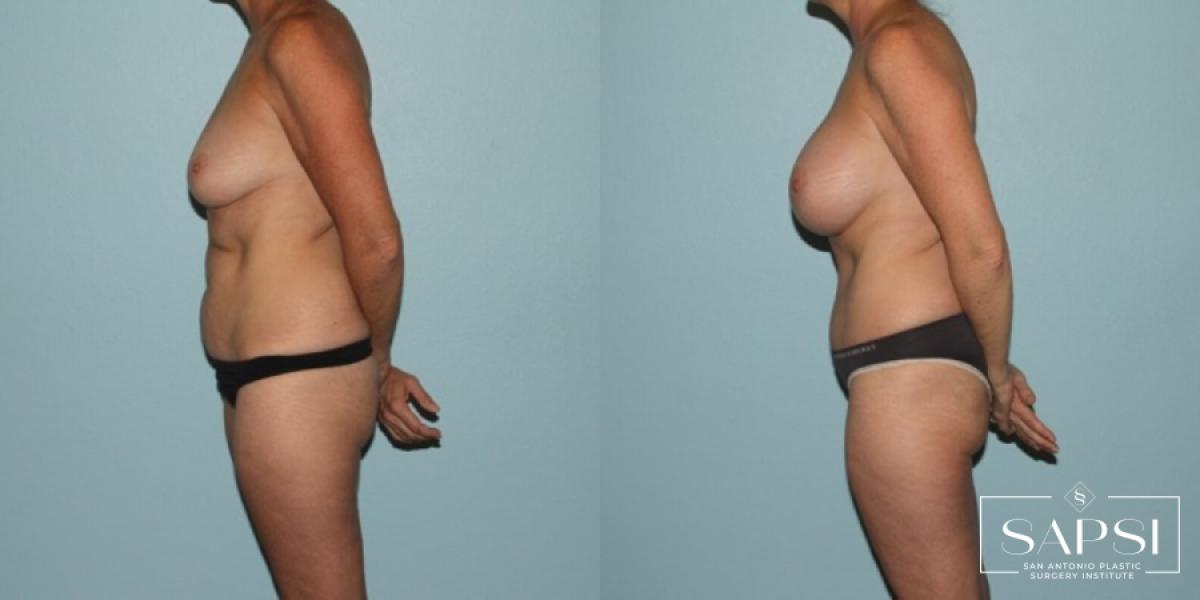 Breast Augmentation: Patient 44 - Before and After 3