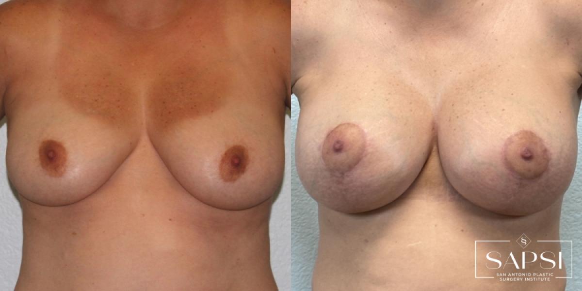 Breast Augmentation With Lift: Patient 20 - Before and After 1