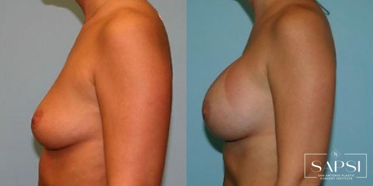 Breast Augmentation: Patient 83 - Before and After 3