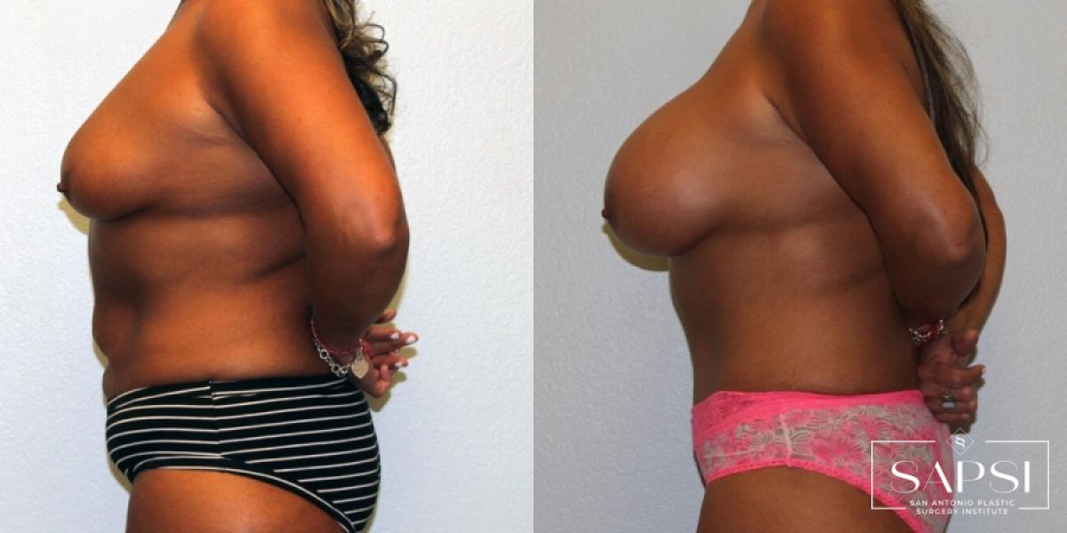 Body Contouring: Patient 6 - Before and After 3