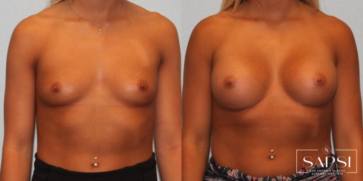 Breast Augmentation: Patient 22 - Before and After 1