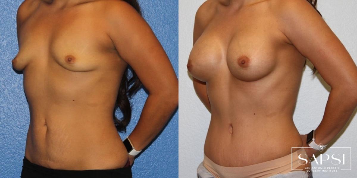 Tummy Tuck: Patient 33 - Before and After 2