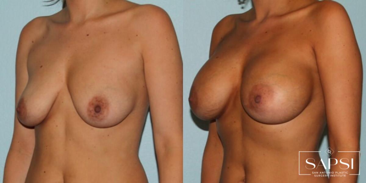 Breast Augmentation: Patient 2 - Before and After 2