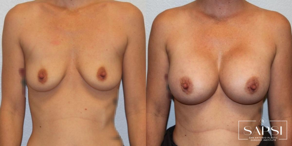 Breast Augmentation: Patient 25 - Before and After 