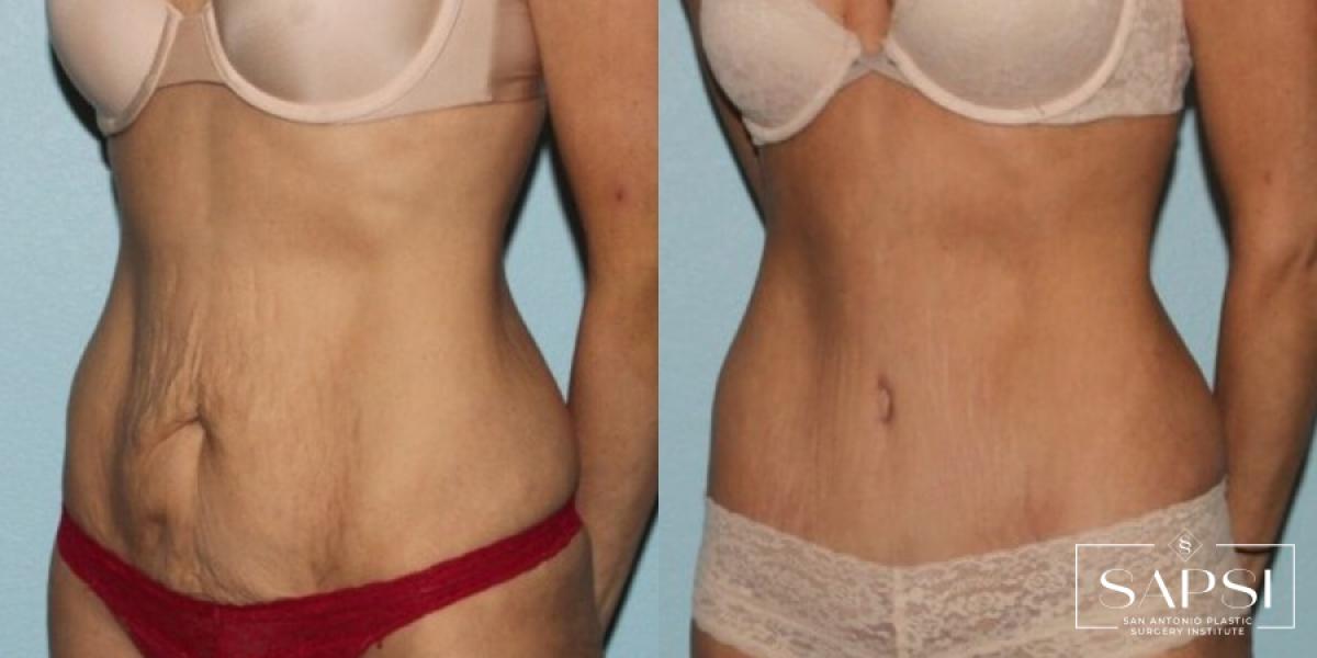 Tummy Tuck: Patient 28 - Before and After 2