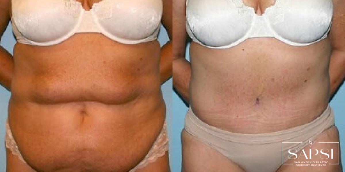 Tummy Tuck: Patient 39 - Before and After 1