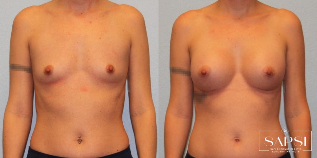 Breast Augmentation: Patient 24 - Before and After 