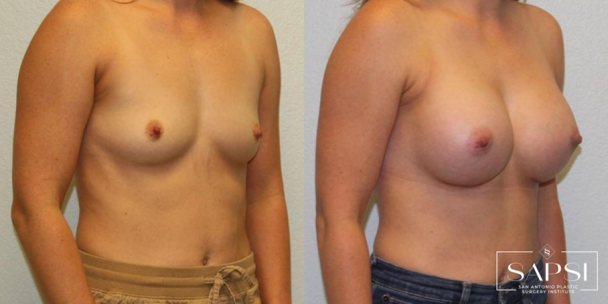 Breast Augmentation: Patient 60 - Before and After 3