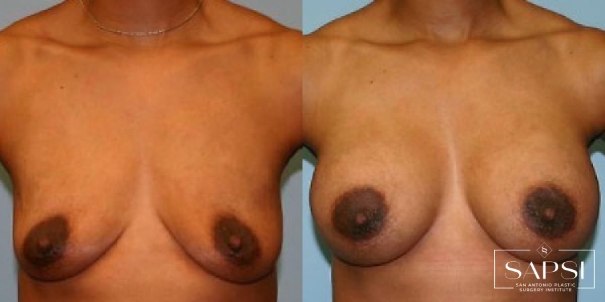 Breast Augmentation: Patient 3 - Before and After  