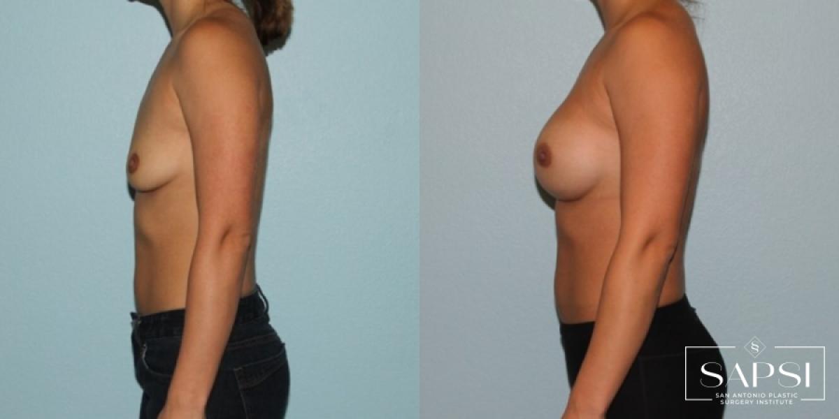 Breast Augmentation: Patient 42 - Before and After 3