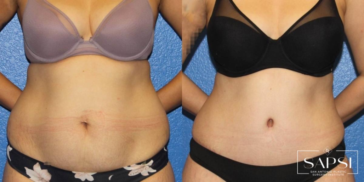 Tummy Tuck: Patient 14 - Before and After 1