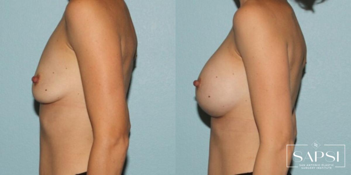 Breast Augmentation: Patient 11 - Before and After 3