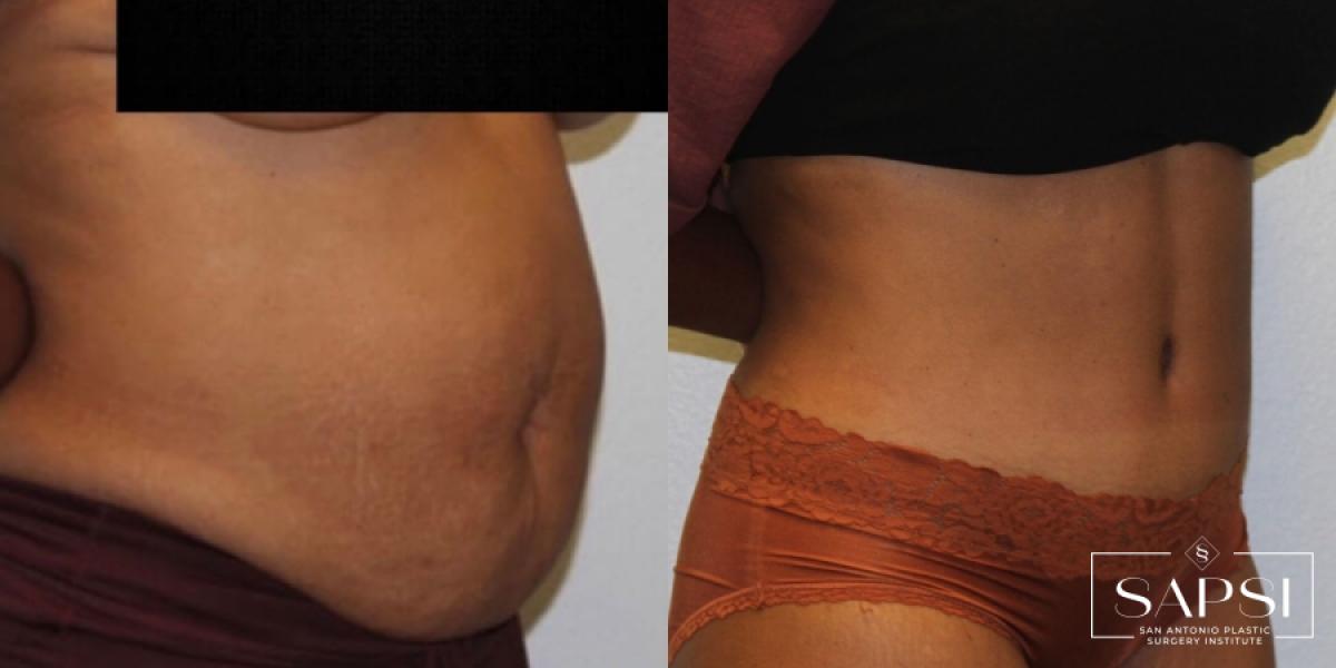 Body Contouring: Patient 3 - Before and After 2