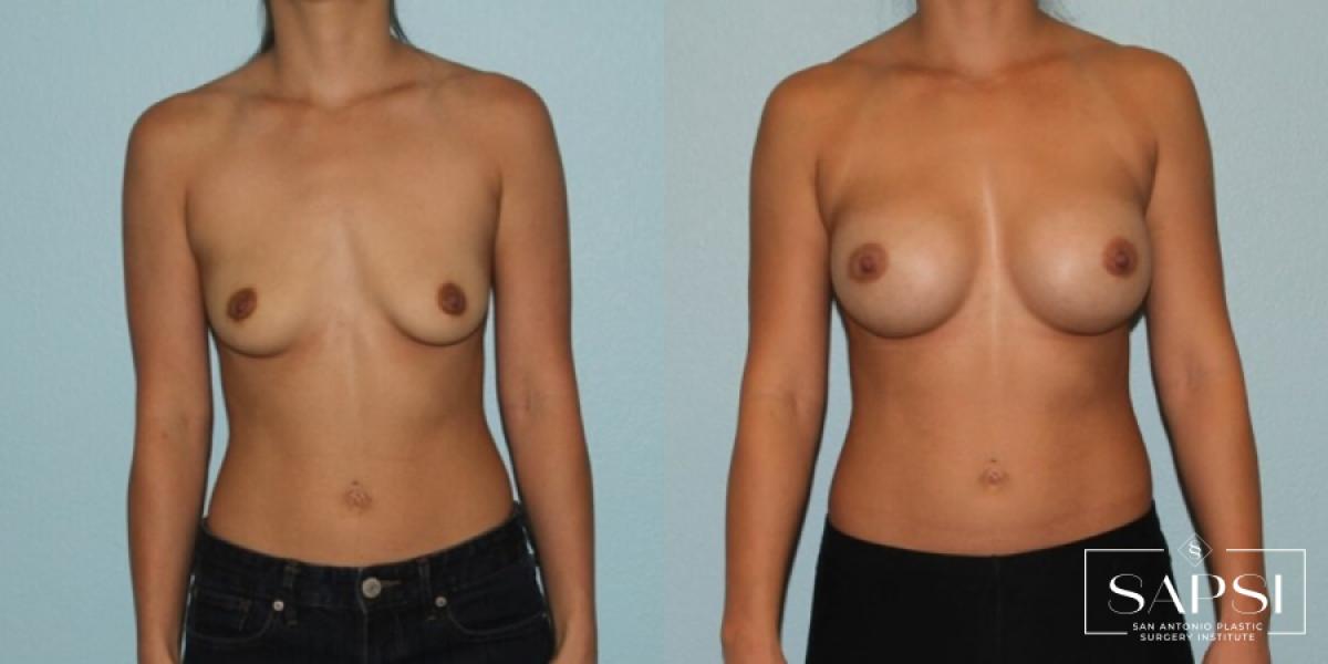 Breast Augmentation: Patient 42 - Before and After 1