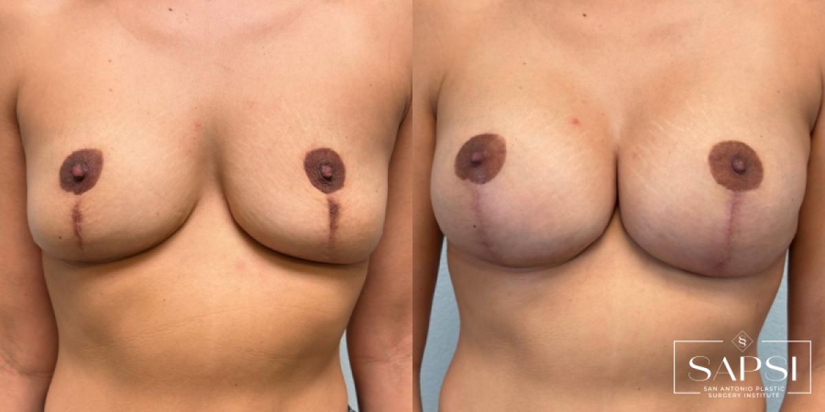 Breast Revision: Patient 11 - Before and After 1