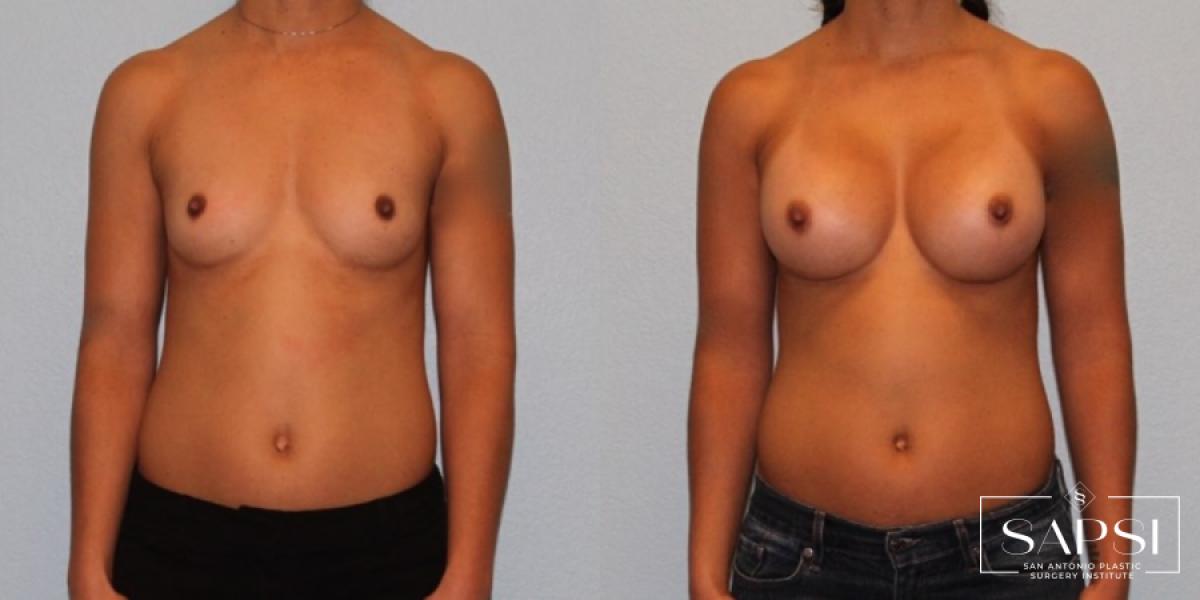 Breast Augmentation: Patient 47 - Before and After 