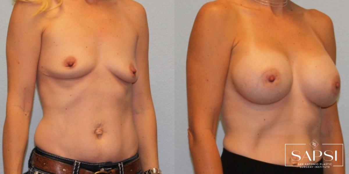 Breast Augmentation: Patient 48 - Before and After 2