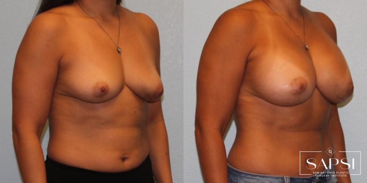 Breast Augmentation: Patient 47 - Before and After 2