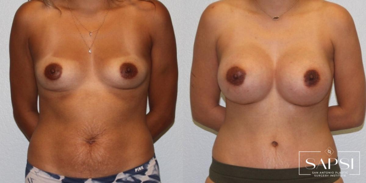 Breast Augmentation: Patient 64 - Before and After 1