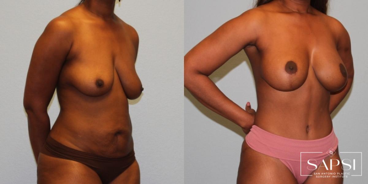 Breast Augmentation With Lift: Patient 18 - Before and After 2