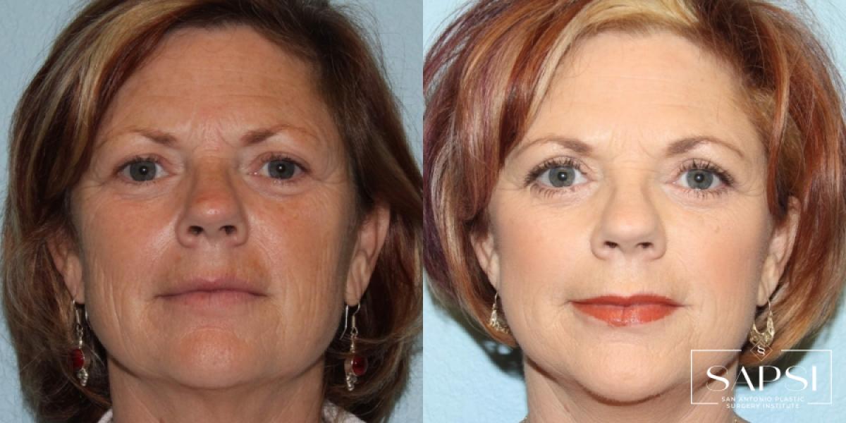 Eyelid Surgery: Patient 1 - Before and After  