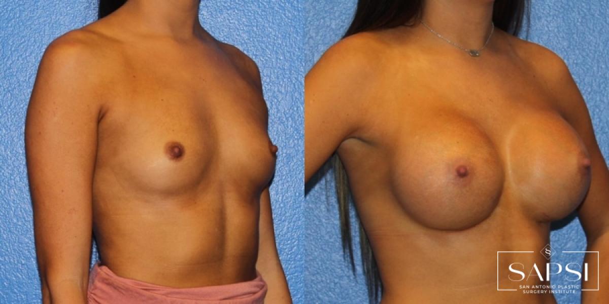 Breast Augmentation: Patient 36 - Before and After 2