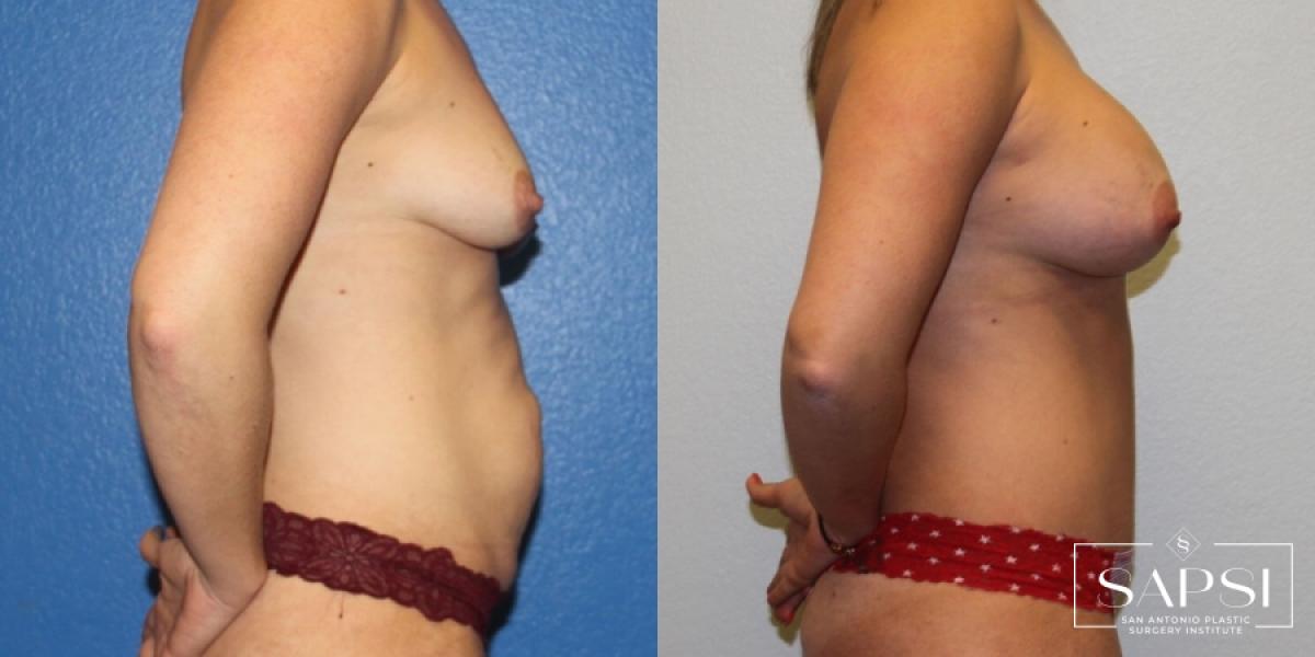 Tummy Tuck: Patient 36 - Before and After 3