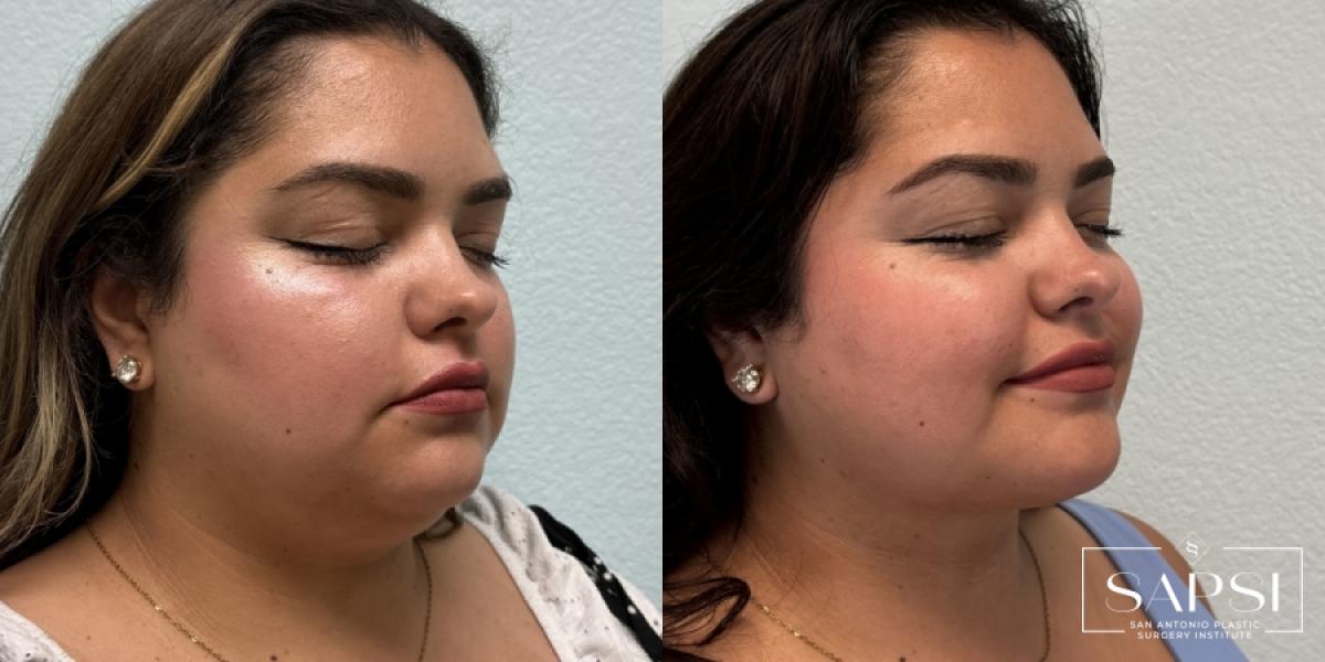 Liposuction: Patient 1 - Before and After 2