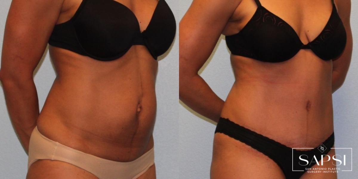 Tummy Tuck: Patient 49 - Before and After 2