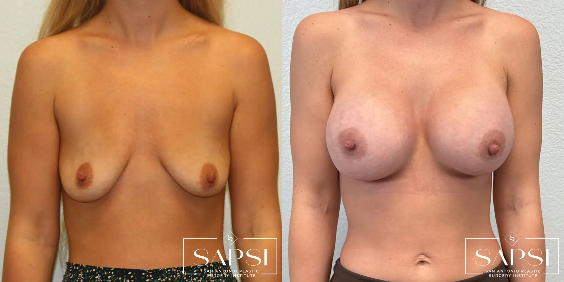 Breast Augmentation: Patient 8 - Before and After