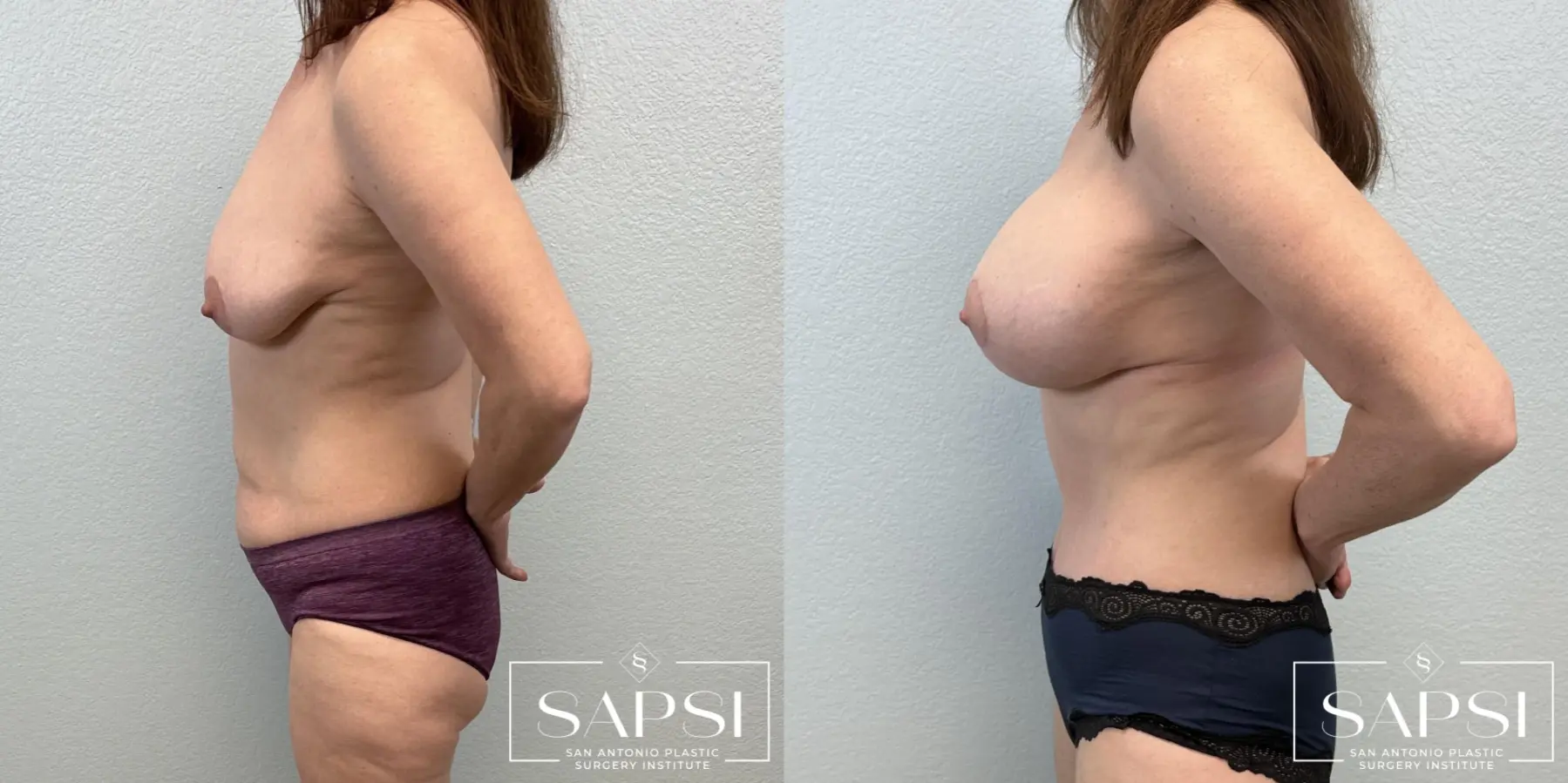 Breast Lift And Augmentation: Patient 1 - Before and After 3