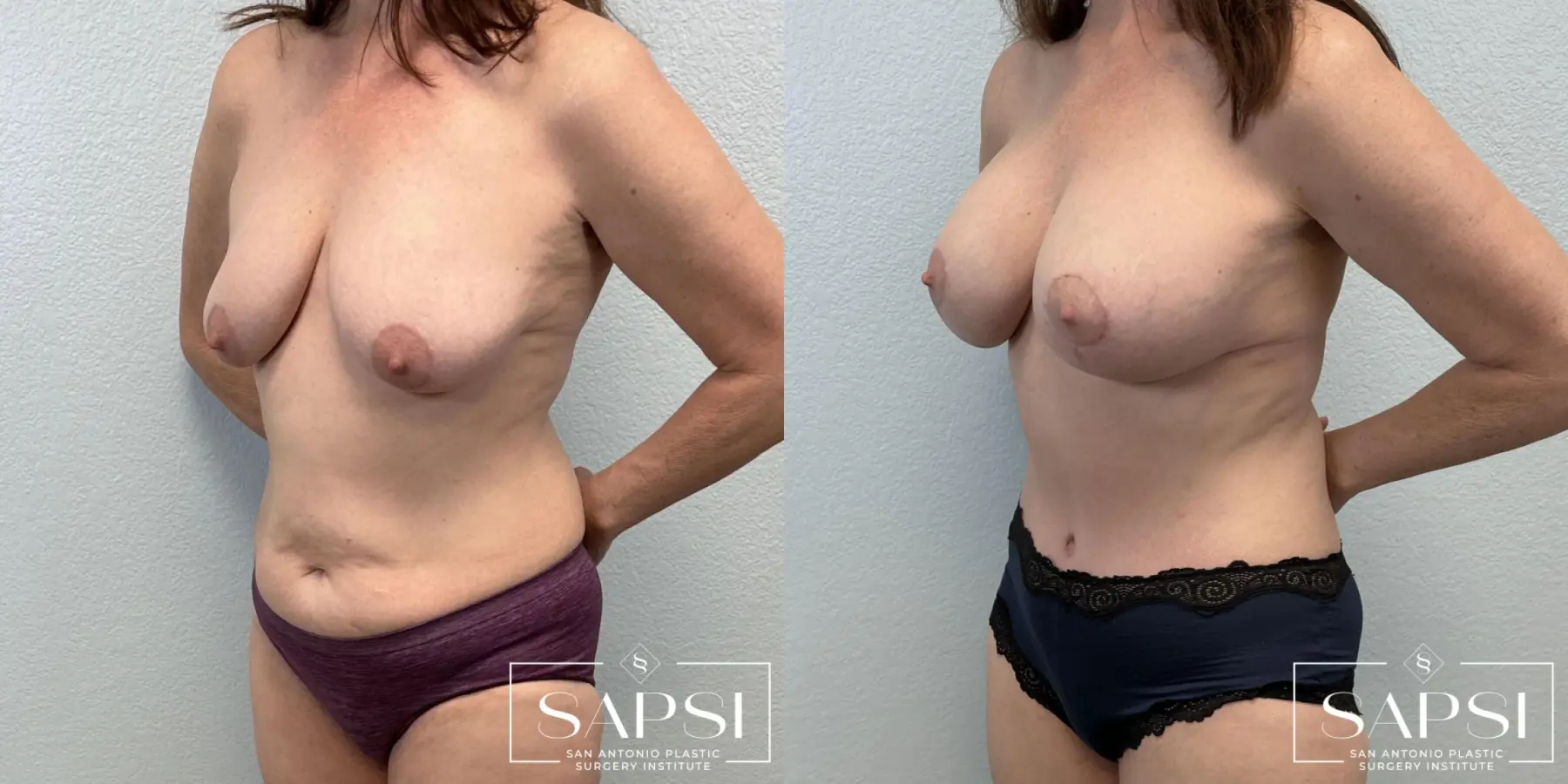 Breast Lift And Augmentation: Patient 1 - Before and After 2