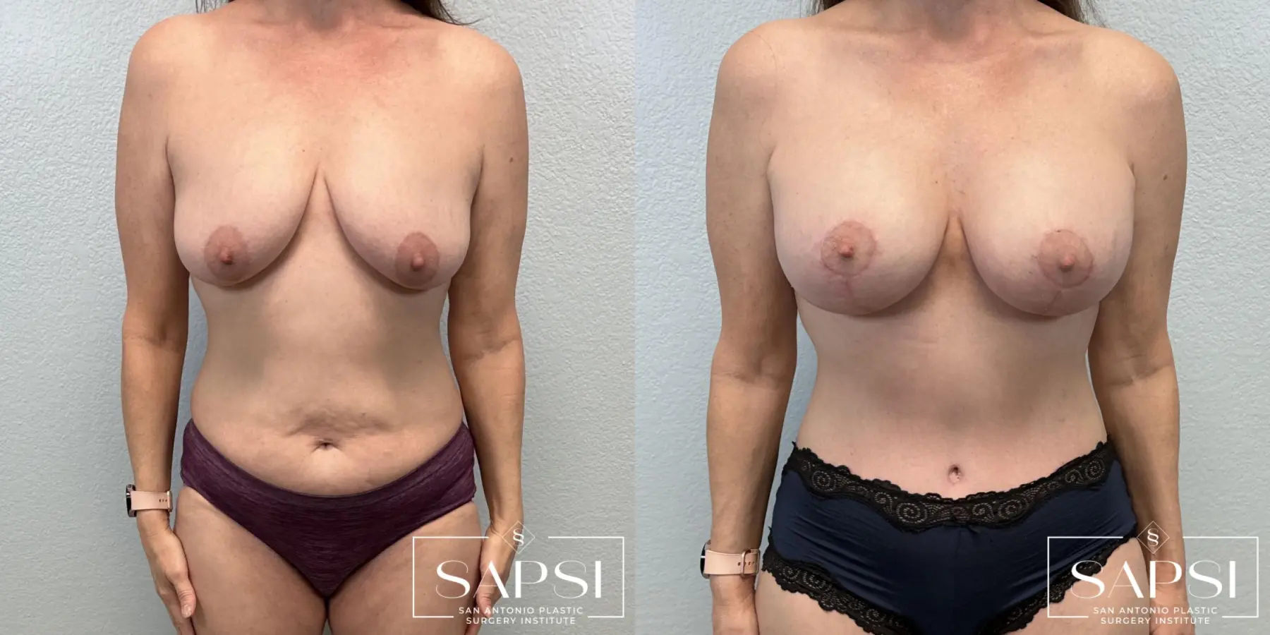 Breast Lift And Augmentation: Patient 1 - Before and After  