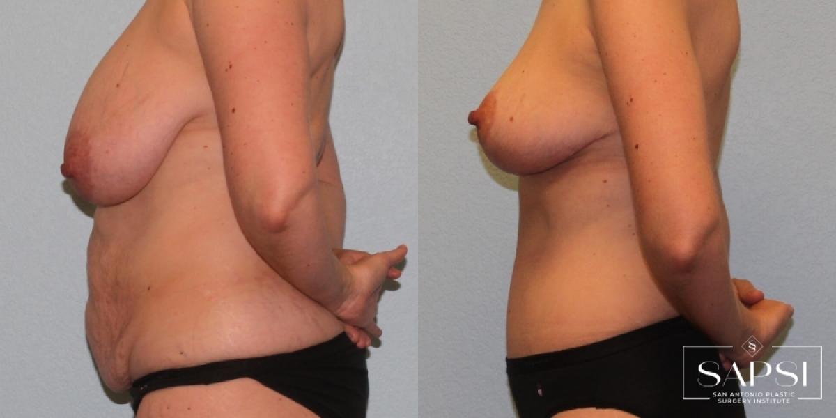 Breast Reduction: Patient 3 - Before and After 3