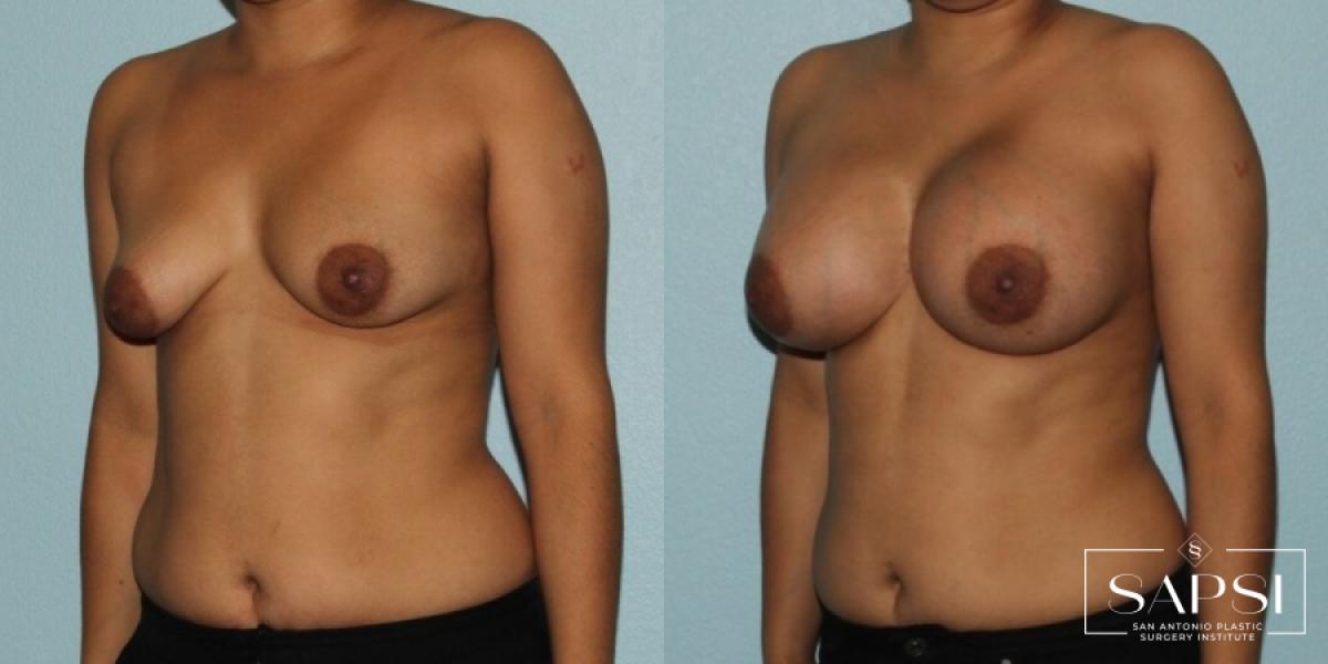 Breast Augmentation: Patient 33 - Before and After 2