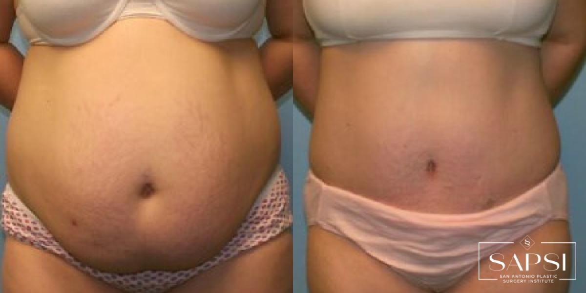 Tummy Tuck: Patient 38 - Before and After 1