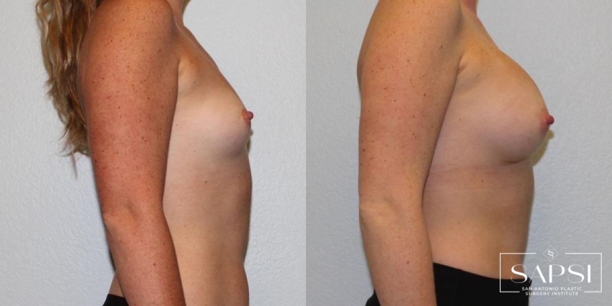 Breast Augmentation: Patient 30 - Before and After 3