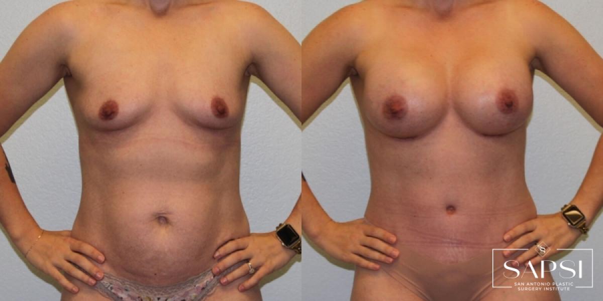 Breast Augmentation: Patient 58 - Before and After 