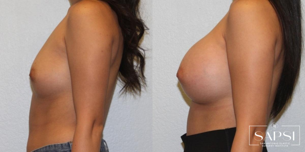 Breast Augmentation: Patient 26 - Before and After 3