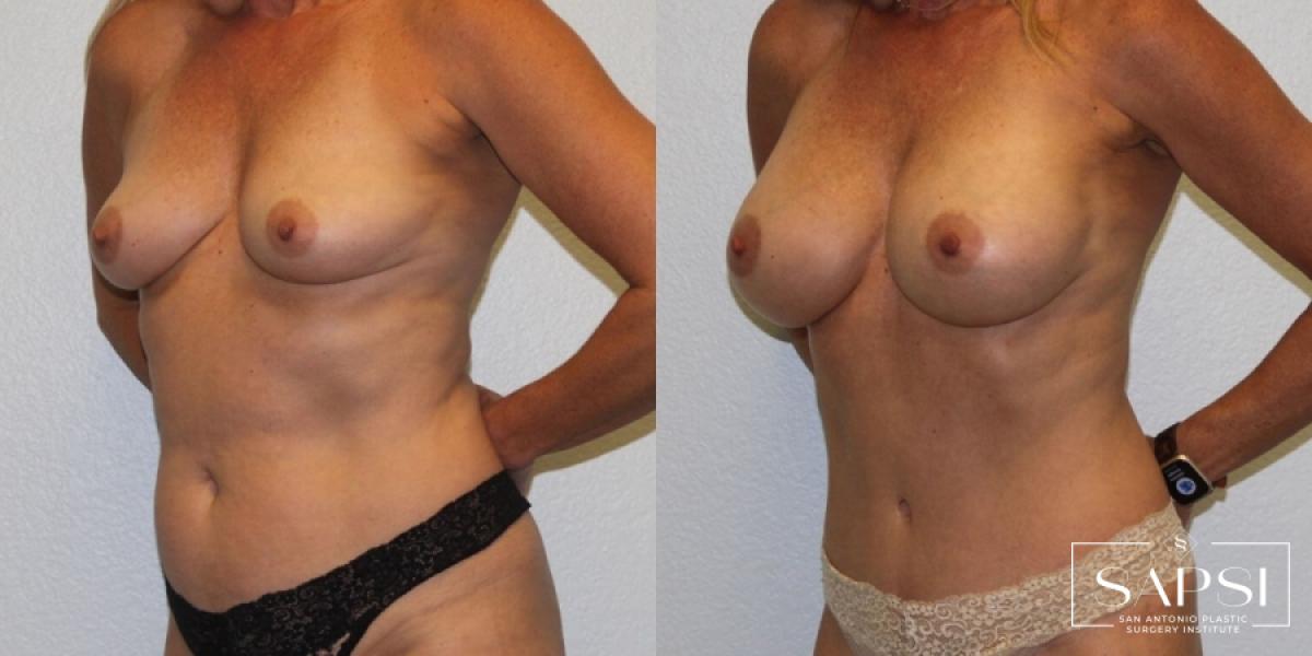 Breast Augmentation: Patient 55 - Before and After 2