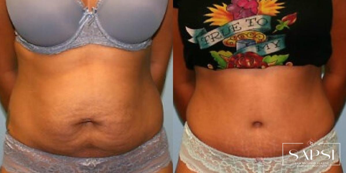 Tummy Tuck: Patient 41 - Before and After 1