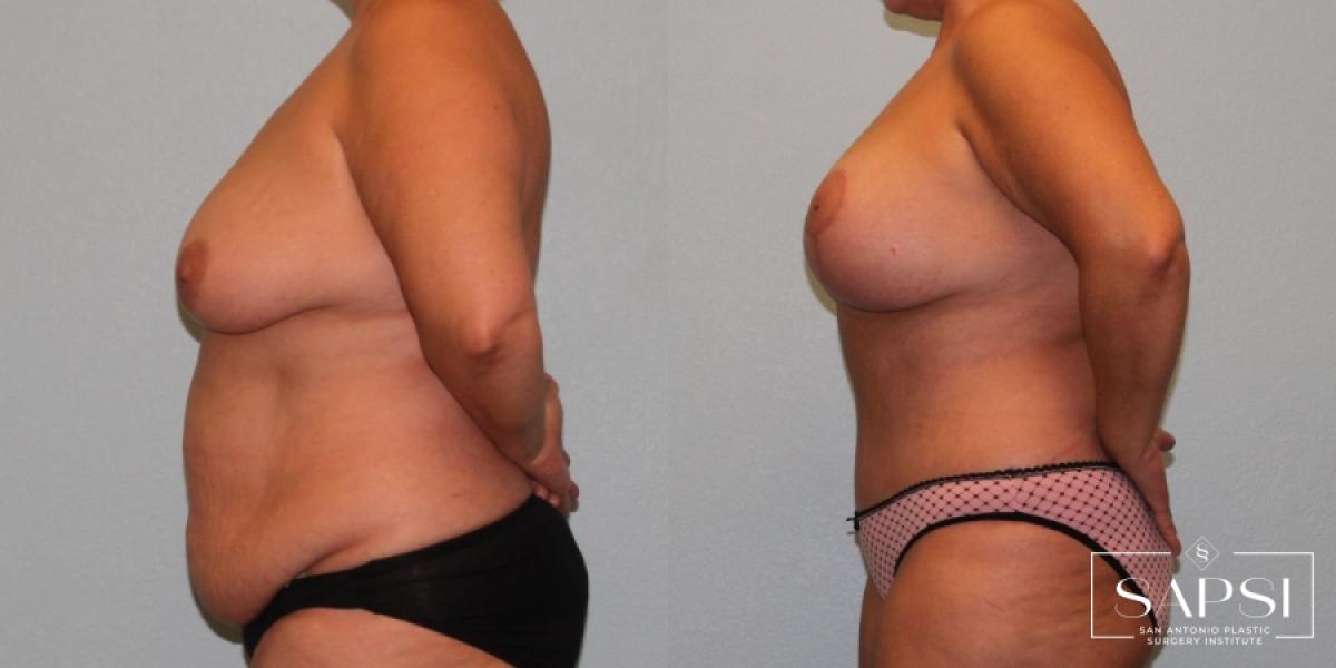 Breast Augmentation With Lift: Patient 14 - Before and After 3