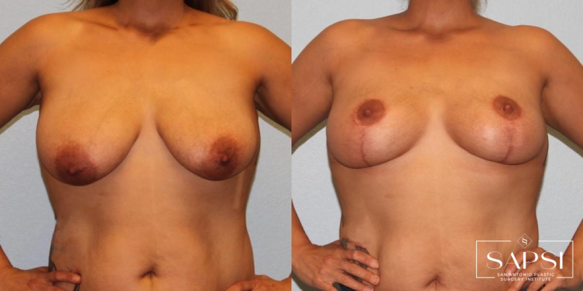 Breast Lift: Patient 14 - Before and After 1